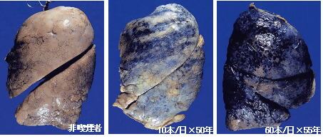 非喫煙が喫煙を始め、1日10本を50年間続けた肺と、1日60本を55年間続けた肺の比較。非喫煙者と比べ、喫煙の頻度が高まるほど真っ黒く変化している。